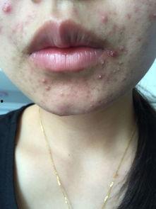 痤疮可以吃脆瓜,脆瓜助力肌肤健康